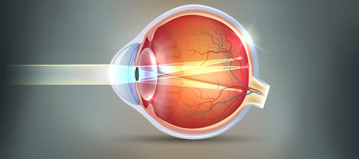 Schnittbild eines Auges mit Hornhautverkrümmung (Astigmatismus)